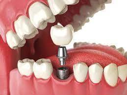 Smile Designing