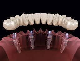 Dental Implants