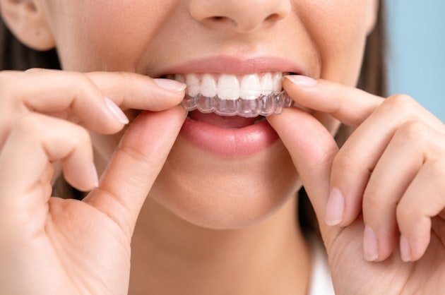 Person fitting a clear orthodontic aligner over the upper teeth