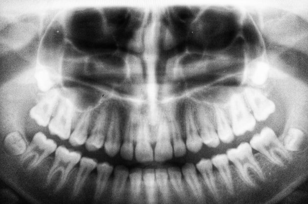 Panoramic dental radiograph showing a full set of upper and lower teeth